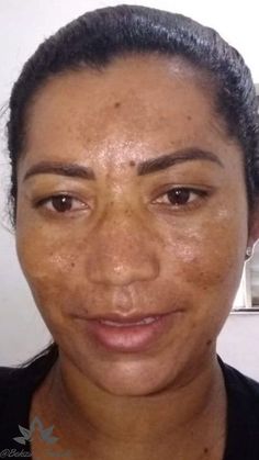 O melasma é uma condição de pele que causa manchas escuras na pele, geralmente na face, devido a fatores como exposição solar, mudanças hormonais e predisposição genética. Tratamentos incluem proteção solar, cremes clareadores e procedimentos médicos, como peelings químicos e tratamentos a laser, Segue para nao perder mais conteúdos! Skin, Beauty, Quick Saves