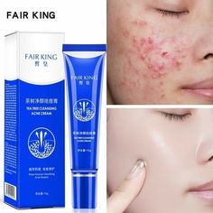 Best Acne Scar Removal, Bentuk Alis, Severe Acne, Acne Scar, Acne Scar Removal, Oil Skin Care, Scar Removal, Acne Spots