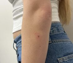 a woman's arm with an acne on the left side of her body