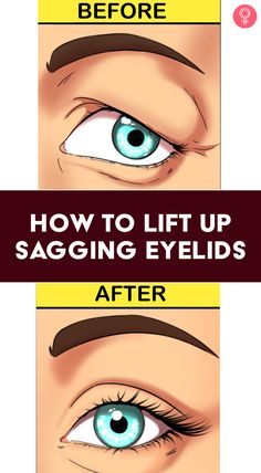 Saggy Eyes Remedies, How To Fix Droopy Eyelids, Sagging Eyelids Natural Remedies, Sagging Eyes Remedies, Saggy Eyelids Remedies, Tighten Eyelids, Sagging Eyelids, Makeup For Saggy Eyelids, Eye Lid Lift Droopy Eyelids