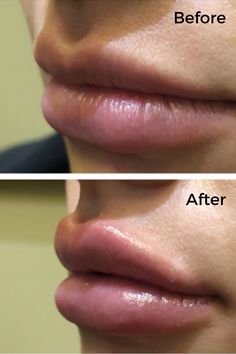 Perfect Lips Injections, Crazy Lipstick, Medical Aesthetics, Lip Enhancement, Kissable Lips, Lip Injections, Medical Aesthetic, Medical Spa