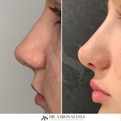 Lip Filler Before And After Side Profile, Cute Noses Profile, Side Nose Profile, Small Alar Base Nose, Lip Fillers Side Profile, Front Nose Profile, How To Fix Your Side Profile, Chin Side Profile, Lip Filler Side Profile