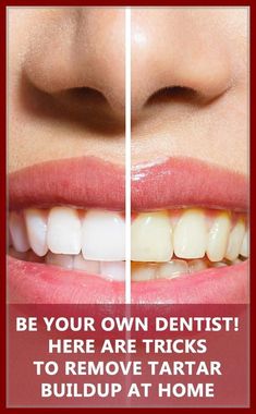 BE YOUR OWN DENTIST! HERE ARE TRICKS TO REMOVE TARTAR BUILDUP AT HOME #HowIsOralCareDone Health Routine, Diy Remedies, Health Facts, Oral Hygiene, Oral Health