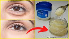 Home Remedy For Bags Under Eyes, Vaseline For Under Eye Bags, Essential Oils For Puffy Under Eyes, Best Way To Get Rid Of Bags Under Eyes, What To Do For Bags Under Eyes, Yea Bags For Eyes, How To Remove Bags Under Eyes Fast, What Helps With Eye Bags, Dark Circles And Wrinkles Under Eyes