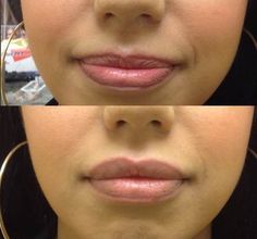 Lip augmentation with restylane Lip Filler Before And After Small Mouth, M Shape Lip Filler, Botox To Lift Corners Of Mouth, 0.5 Ml Lip Filler Before And After, Lip Injections Before And After 0.5ml, Double Eyelid, Lip Augmentation, Dermal Fillers, Surgery