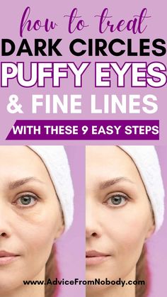 Puffy Eyes Remedies That Work! How to get rid of puffy eyes, dark circles, fine lines, crow's feet, and under-eye bags, the best tips to avoid them, along with DIY remedies, products, and hacks! Whether you have chronic under-eye circles, puffiness due to allergies, or you just need makeup tips for mornings you're extra tired and need to look awake, this post has you covered! Dark circles under eyes| Puffy eye treatment| Eye bags treatment| Eye bag remedies| Puffy bags under eyes. Eye Bags Remedy, Tired Eyes Remedy, Get Rid Of Eye Bags, Rid Of Eye Bags, Eyes Dark Circles, Dark Circle Remedies