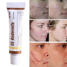 Acne Scar Removal Cream, Snake Oil, Acne Oil, Dark Spots On Skin