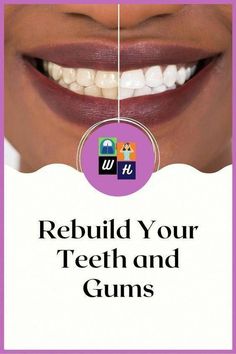 Fix Teeth, Gum Recession, Teeth Health, Oral Care Routine, Receding Gums, Gum Care, Dental Problems, Teeth Care, Oral Health Care