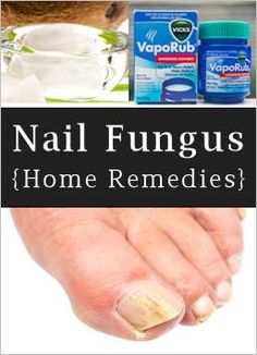 Toenail Fungus Remedies, Vicks Vaporub, Toenail Fungus, Nail Fungus, Homemade Remedies, Natural Home Remedies, Health And Beauty Tips, Natural Medicine, Health Remedies