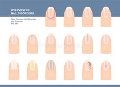 Nail Diseases And Disorders Chart, Blue Nail Polish Colors, Fluorescent Nails, Best Summer Nail Color, Clothes Videos, Diseases And Disorders, Different Types Of Nails, Nail Problems