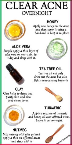 Acne is something we all struggle to get rid of, while some treatments work others don’t. Acne or pimples if not treated or prevented at the right time can worsen and also leave behind nasty Clear Acne Overnight, Clear Skin Overnight, Lotion For Oily Skin, Turmeric And Honey, Acne Overnight, Natural Acne Remedies, Natural Acne, How To Get Rid Of Pimples, Aloe Gel