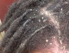 Hair Scalp Problems, Itchy Flaky Scalp, Dry Flaky Scalp, Dandruff Causes, Dandruff Flakes, Shampoo For Dry Scalp, Scalp Problems