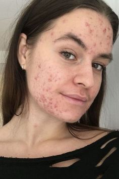 Acne Girl, Accutane Before And After, Girl With Acne, Acne Positivity, 100 Challenge, Acne Beauty