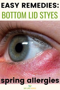 Dealing with a stye? These fast stye treatments, self-care tips, and at-home remedy ideas can help you heal quickly, and reduce the swelling, pain and discomfort. Treat styes naturally with these gentle stye treatments and simple solutions. Click the link for tips that are perfect for anyone looking for quick or overnight stye relief.