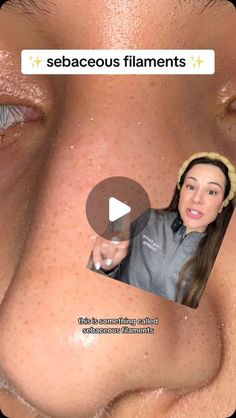 Lindsey Zubritsky, MD, FAAD on Instagram: "Comment FILAMENTS below and I’ll DM ya a list of my favorite treatments!   Be honest: how many of you have called this little things blackheads? Sound off below 👇" Dm Must Haves, Blackheads On Face, Sebaceous Filaments, Steaming Your Face, Face Steaming, Pimples Under The Skin, Blackhead Remover Tool, Dermatological Skin Care, Sound Off