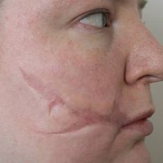 a woman with acne on her face