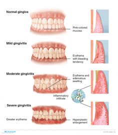 Dental Radiology, Dental Illustration, Dental Stickers, Gum Graft, Dental Pictures, Hygiene School, Dental Assistant Study, Dental Hygiene Student, Dental Posters