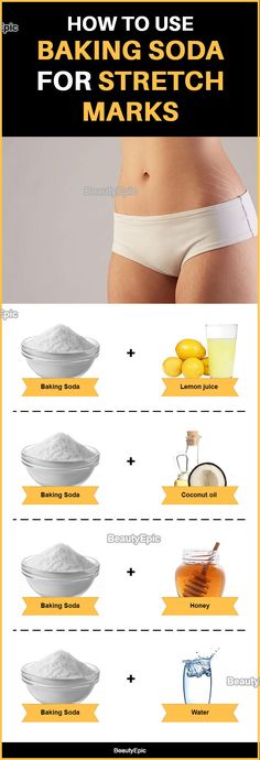 How To Remove Stretchmarks Naturally, Stretches Marks, How To Remove Strechmark, Baking Soda Lemon Juice, Baking Soda And Honey, Baking Soda Coconut Oil, Strech Marks, Stretch Mark Remedies, Honey Beauty