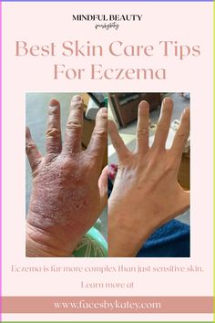 Learn what eczema and skin sensitivities are, and tips for how to care for eczema with skin care, common triggers, and more ways to support calm healthy skin. Excema Treatments Diy, Severe Excema Remedies, Exema Treatments Natural, Excema Remedies Diy, Common Triggers, Rash On Face, Cucumber Detox Water, Lemon Cucumber, Hydrating Drinks