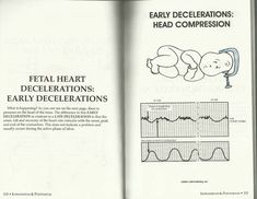 Fetal Heart Monitoring, Postpartum Hemorrhage, Nclex Questions, Ob Nursing, Nursing Study