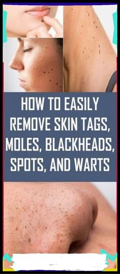 Destroy Your Moles, Warts, Blackheads, Skin Tags And Age Spots Completely Naturally Warts On Hands, Remove Skin Tags, Warts On Face, Food House, Skin Moles, Black Heads, Diy Spices, Healing Remedies