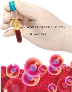 Prp Facial, Skincare Dermatologist, Nursing Goals, Remedies For Tooth Ache, Vampire Facial, Prp Hair, Brooklyn Newyork, Skin Facts, Platelet Rich Plasma