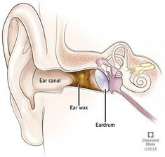 Earwax blockage — also called cerumen impaction — may result in irritation, tinnitus and hearing loss. Treatments include drops to soften the wax or manual removal at your healthcare provider’s office. Swimmers Ear Remedy, Swimmers Ear, Ear Wax Removal Tool, Human Ear, Hearing Health, Ear Health