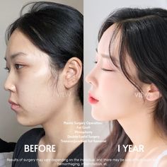 before and after photos of a woman's nose with rhinoplast surgery on her left side