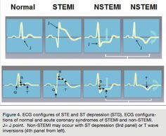 pericarditis vs stemi ecg - Google Search Stemi Vs Nstemi, Nursing School Essential