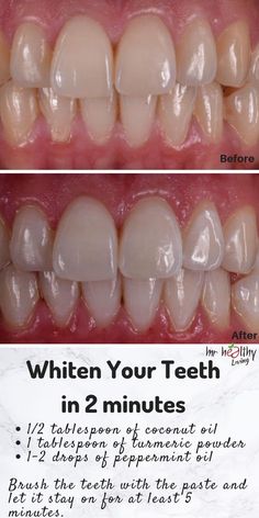 Turmeric Teeth Whitening