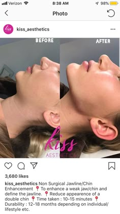 Perfect Chin Shape, Jaw And Chin Filler, Face Contouring Fillers, Facial Balancing Filler, Chin Fillers Before After, Nose Profile, Chin Filler, Facial Procedure