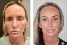 Curious if you can get a facelift in your 40s and what your options are. Find out why more women are opting for a facelift in their forties! Deep Plane Facelift, Mini Face Lift, Facelift Surgery, Sagging Cheeks, Facelift Procedure, Facial Aging, Facial Procedure, Face Lift Surgery, Fat Grafting