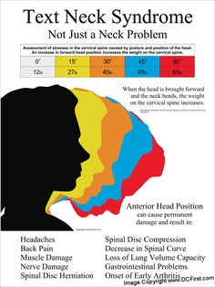 Text Neck Syndrome Poster K Tape, Text Neck, Forward Head Posture, Neck Problems, Massage Benefits, Neck And Back Pain, Chiropractic Care, Massage Therapist