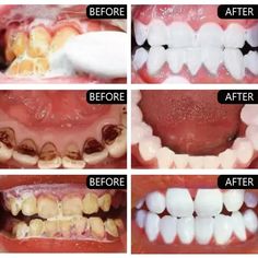 Fast Remove Smoke Stains Toothpaste Remove Plaque Stains Oral Hygiene Cleaning Fresh Breath Teeth Dental Bleaching, Dental Mouthguards, Tooth Gel, Teeth Whitening Toothpaste, Grills Teeth, Teeth Whitening Pen, Tooth Powder, Teeth Whitening Strips, Dental Cleaning