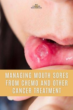 Mouth sores are a common side effect of cancer treatment. From small red spots to large ulcers that cover the entire inside of the mouth, these painful sores can make it difficult to talk, swallow, eat, drink, and sometimes even breathe. Here we’ll discuss what mouth sores from chemo are, how they develop and to how to prevent and treat them. Chemo Mouth Rinse, Sores In Mouth From Chemo, Chemo Mouth, Chemo Tips, Chemo Side Effects, Simple Stretches, Toxic Free Living, Mouth Rinse