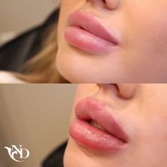 A before and after image of a lip filler treatment at A New Dawn Wellness Center in Scottsdale, AZ Lip Filler 2 Syringe, Lip Filer Styles, Full Syringe Lip Filler Before And After, 1 Syringe Lip Filler, Lip Fillers Shapes, Lip Filler Shape Ideas, Desired Lips, Lip Filler Inspiration