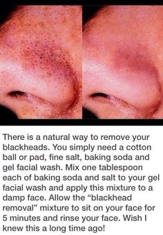 JOJO POST FOREVER YOUNG: Blackhead Remedies, Black Heads, Blackhead Removal, Homemade Beauty Products, Facial Wash, Blackhead Remover, Skin Tips, Health And Beauty Tips