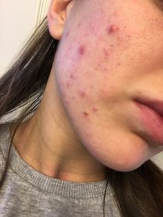 Acne Aesthetic Girl, Acne Reference, Pimples Aesthetic, Acne Skin Aesthetic, Girls With Acne, Arm Acne