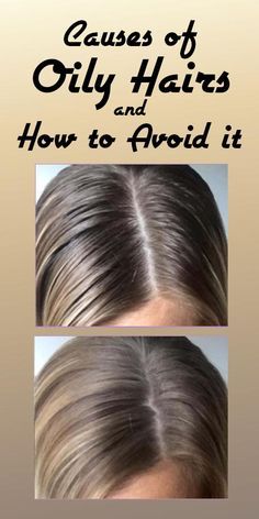 Hair Masks For Oily Scalp, Help Oily Hair, Natural Remedies For Oily Hair, Diy Hair Mask For Greasy Hair, Oily Scalp Hairstyles, Diy Oily Hair Remedies, What Helps With Dandruff, Oily Scalp Remedy Diy