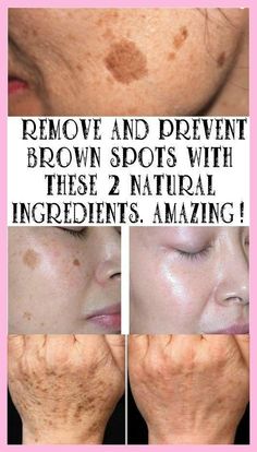 Brown Spots On Skin, How To Get Rid Of Pimples, Skin Spots, Baking Soda Shampoo, Brown Spots, Skin Issues