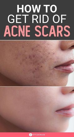 #BestNaturalRemedyForCough How To Get Rid Of Acne Redness Fast, Best Home Remedy For Acne Scar, How To Get Rid Of Face Acne, Pimple Acne Remedies, Acne Spot Removal, Face Acne Scar Removal, Face Spots How To Get Rid, Pock Marks Remedy, How To Get Rid Of Pimples Marks