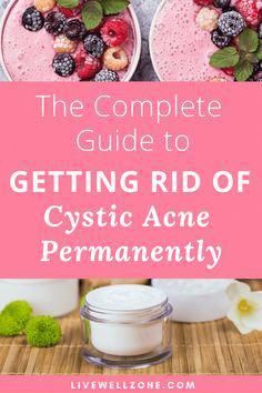 Tips on how to get rid of hormonal acne naturally and faster without birth control. Includes diet, supplements + skin care products. Cystic Acne Diet Plan, Acne Diet Plan Hormonal, Acne Meal Plan, Get Rid Of Cystic Acne, Acne Diet Plan, Nodule Acne, Acne Journey, Treating Cystic Acne