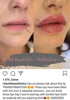 Lip Filler Shape Ideas Black Women, Lip Filler Shape Ideas, Lip Filler Inspiration, Filler Inspiration, Lip Fillers Juvederm, Face Plastic Surgery, Dermal Fillers Lips, Lips Quotes, Lips Fillers