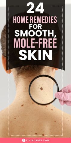 If you are bothered by a mole on your face or body, don’t worry. There are various natural remedies available for treating skin conditions like moles. Here, we have listed some home remedies for mole removal. But first, let’s understand what moles are.