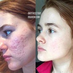 Here are the top ways to remove acne scars fast with scientifically proven results. From acne scar home treatments, acne scarring skincare products, and procedures you can do in office. Acne Photos, Treating Acne, Acne Overnight, Get Rid Of Acne, Rid Of Acne, Natural Acne Remedies, Acne Scar, Acne Scar Removal