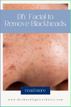 squeezing blackheads, blackheads popping, blackheads on face, clean blackheads, blackheads removal, blackhead removal cream, how to get rid of blackheads on nose, how to remove blackheads, diy blackheads removal, Blackhead Removal Facial Guide, DIY Facial for Clear Skin, Effective Home Remedies, Facial Tips for Blackhead Removal, Skincare at Home Blog, Step-by-Step Facial Routine, Clearing Blackheads Article, Easy Facial Steps, DIY Facial for Skin Health, Blemish-Free Skin Tips How To Clear Blackheads On Face, Diy Blackheads Removal, Clearing Blackheads, Facial Steps, Blackheads Removal Cream, Squeezing Blackheads, Blackheads On Face, Coldsore Remedies Quick, Diy Facials