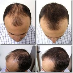 Scalp Micropigmentation, About Life, Wig Hairstyles, Insurance, Facial, Wigs, Spray