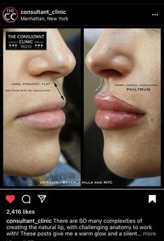 Dermal Fillers Lips, Aesthetic Dermatology, Face Lift Surgery, Facial Contouring