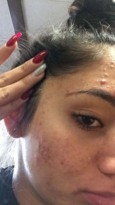 PHOTO: Karina Banuelos, 17, shared this photo of her severe acne before she cleared it up with a skincare routine featuring four cheap products. Remedies For Acne And Pimples, Make Up On Acne Skin, Teen Acne Skincare Routine, Yeast Acne, How To Clear Up Acne, Acne Images, Acne Photos, Teen Facial, Beautiful Acne