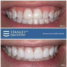 veneers cary raleigh carync durham raleighnc teeth transformation beforeandafter happiness NC southern dentist dentistry cosmeticdentist cosmeticdentistry Teeth Transformation, Cary North Carolina, Tooth Enamel, Natural Teeth, Bright Smile, Dental Services